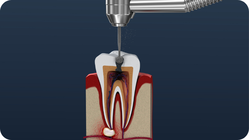 Thumbnail-Dipsciplines-of-dentistry-endodontics