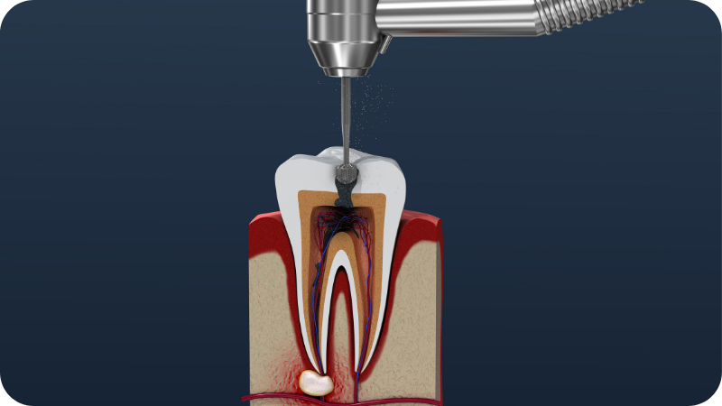 endodontics