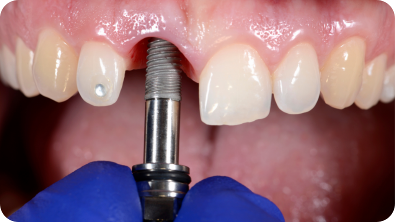 Thumbnail-Dipsciplines-of-dentistry-implants