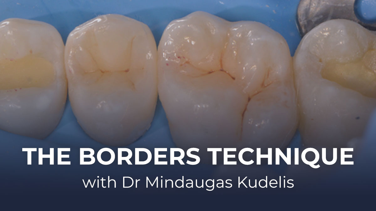 The Borders Technique with Dr Mindaugas Kudelis