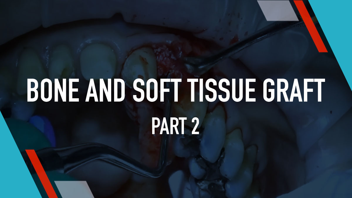 Bone and Soft Tissue Graft - Part 2
