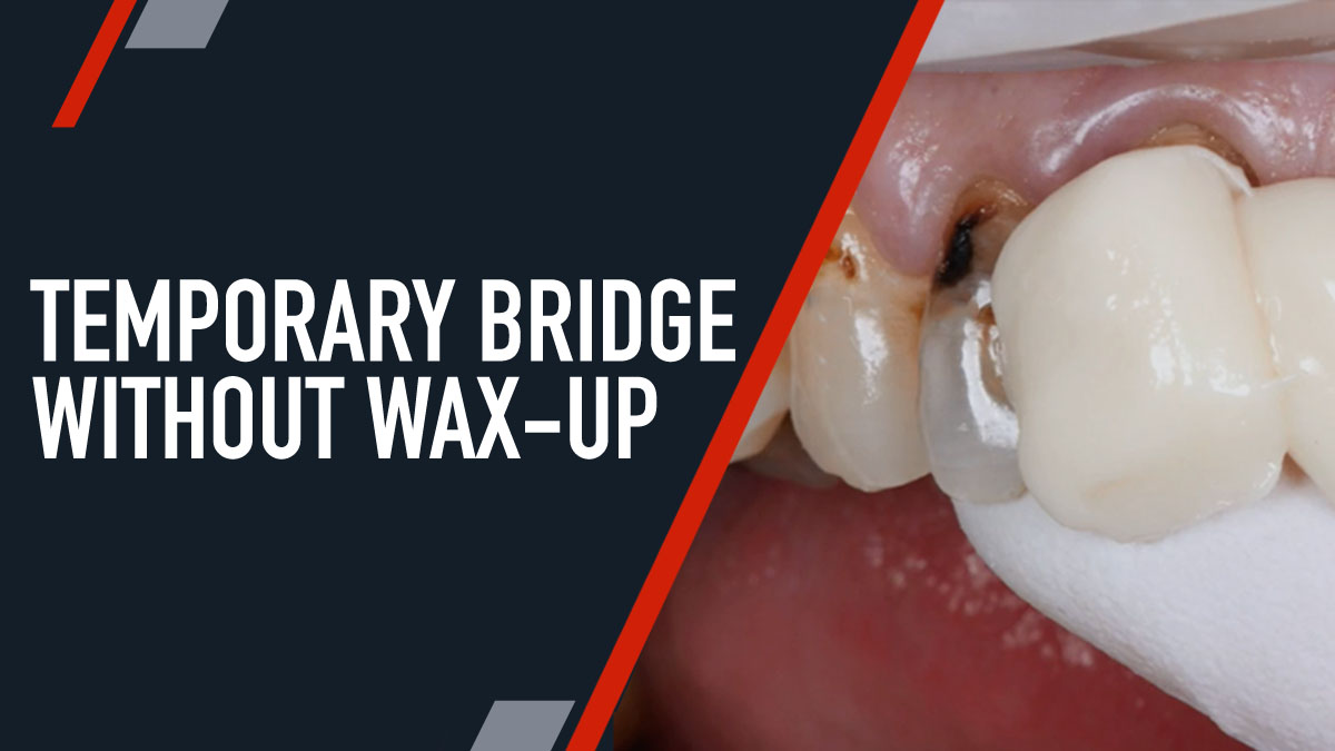 Temporary Bridge Without Wax-Up