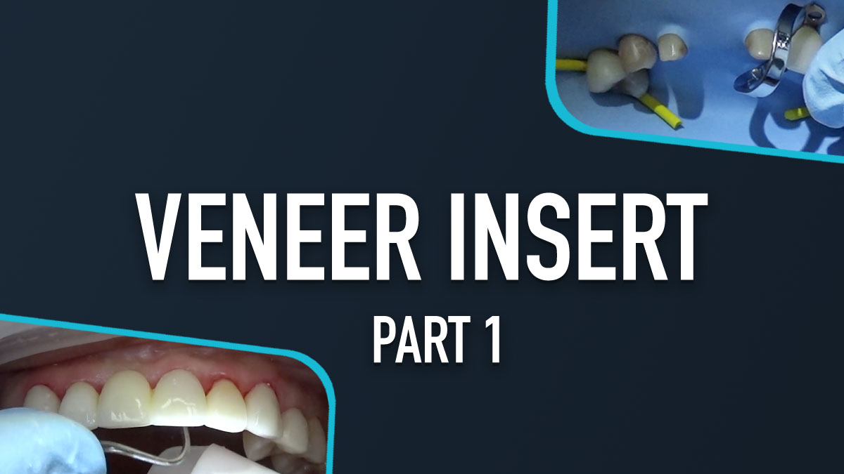 Veneer Insert - Part 1