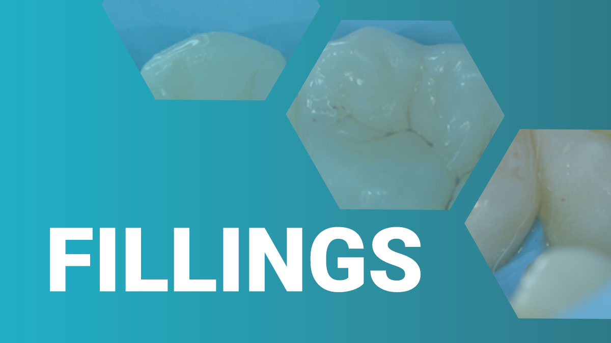 Fillings Dental Training Videos