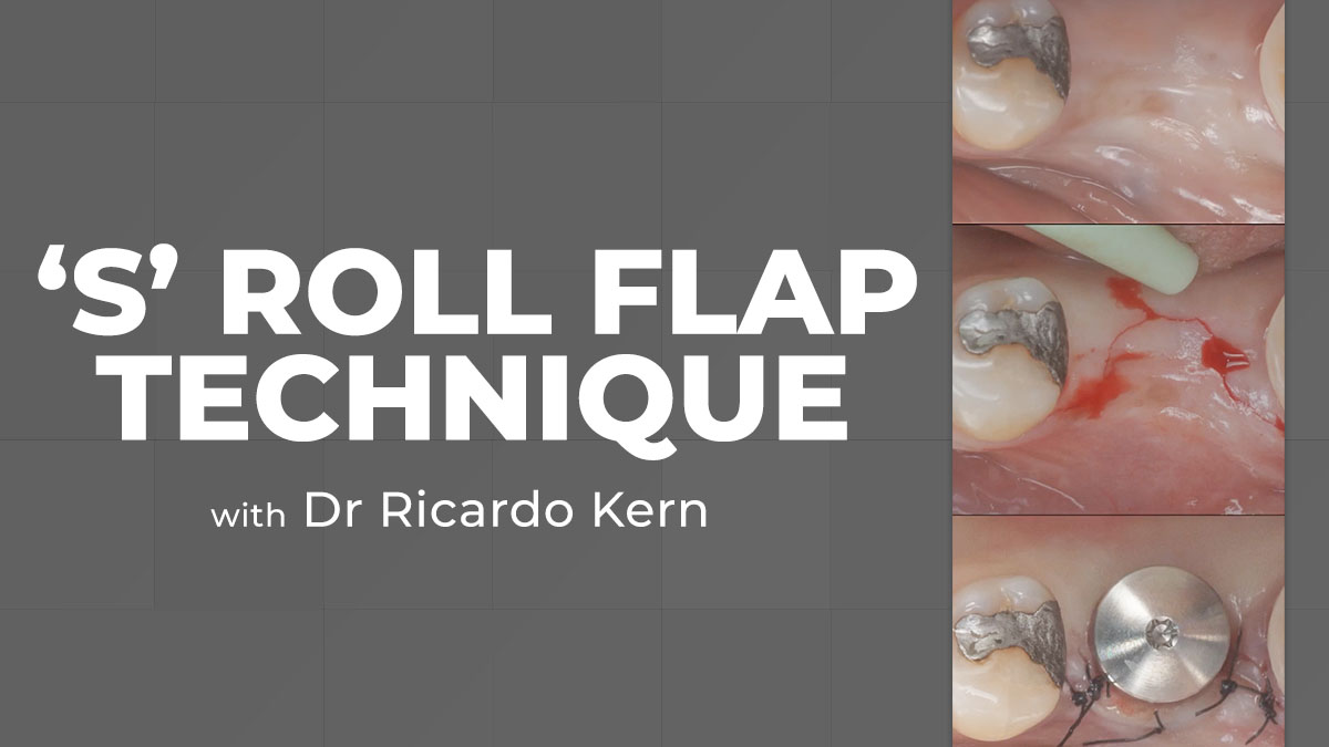 The “S” Roll Flap Technique