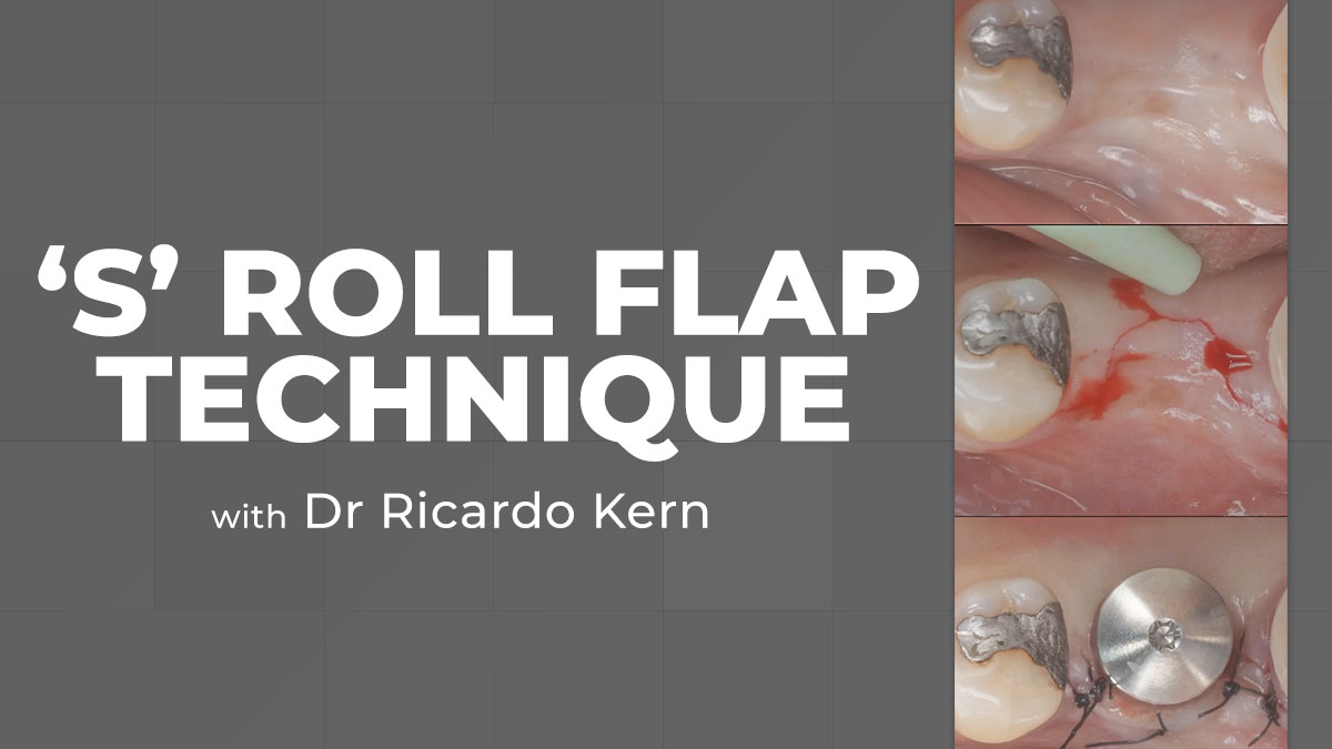 The “S” Roll Flap Technique