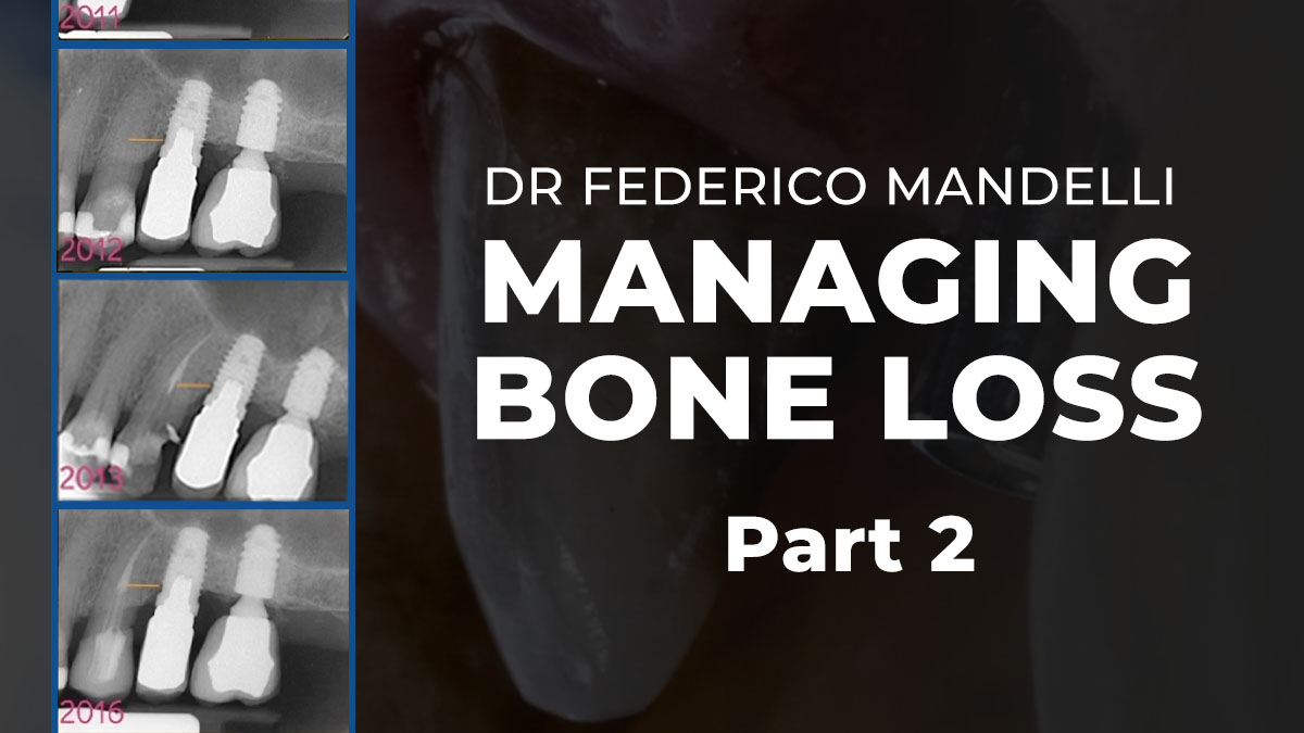 Managing Bone Loss - Part 2