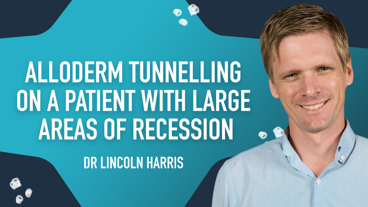 Alloderm Tunnelling on a Patient with Large Areas of Recession