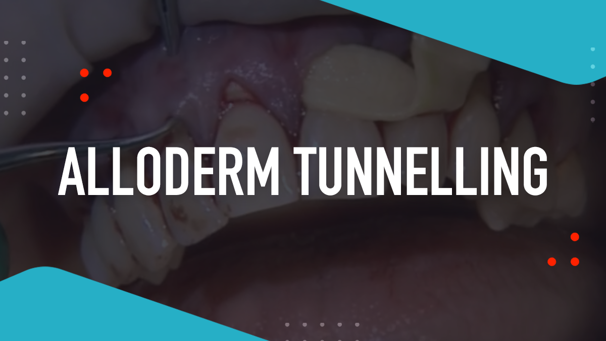 Alloderm Tunnelling
