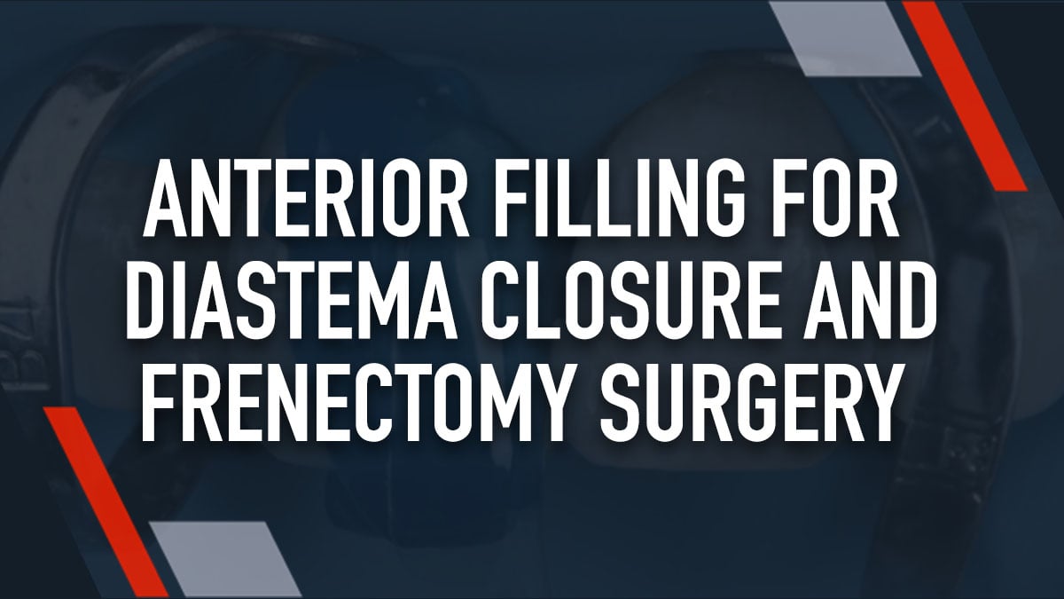 Anterior Filling for Diastema Closure and Frenectomy Surgery