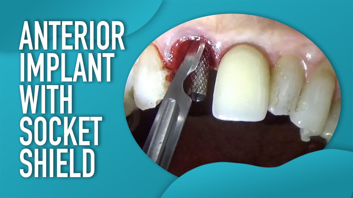 Anterior Implant with Socket Shield