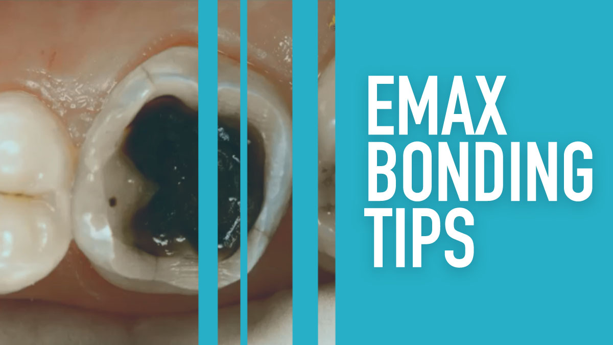 Emax Bonding Tips