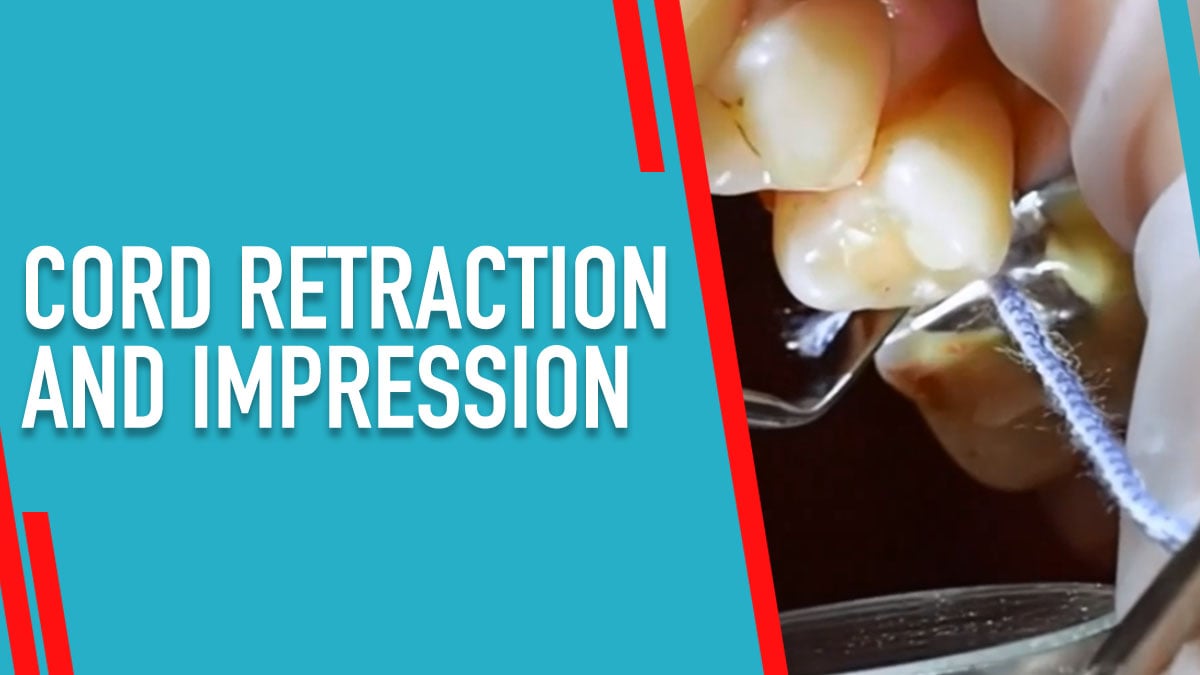 Cord Retraction and Impression