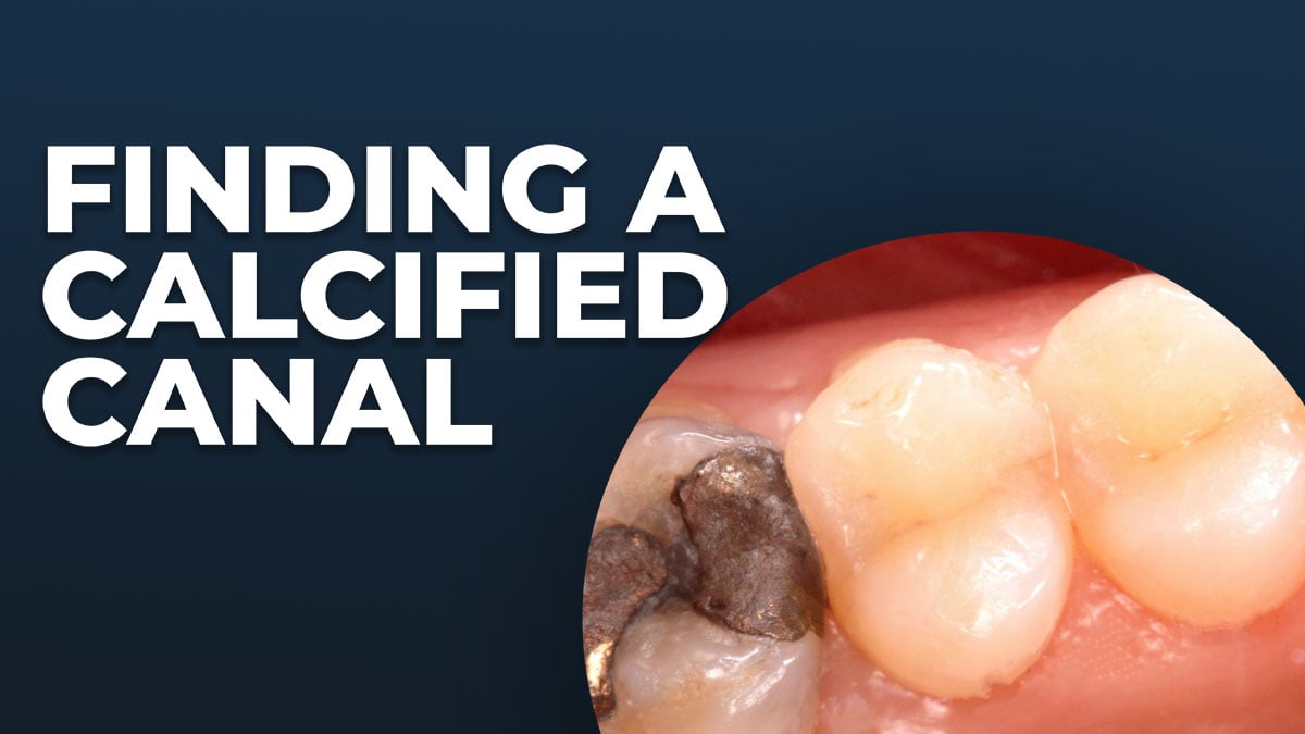 Finding a Calcified Canal