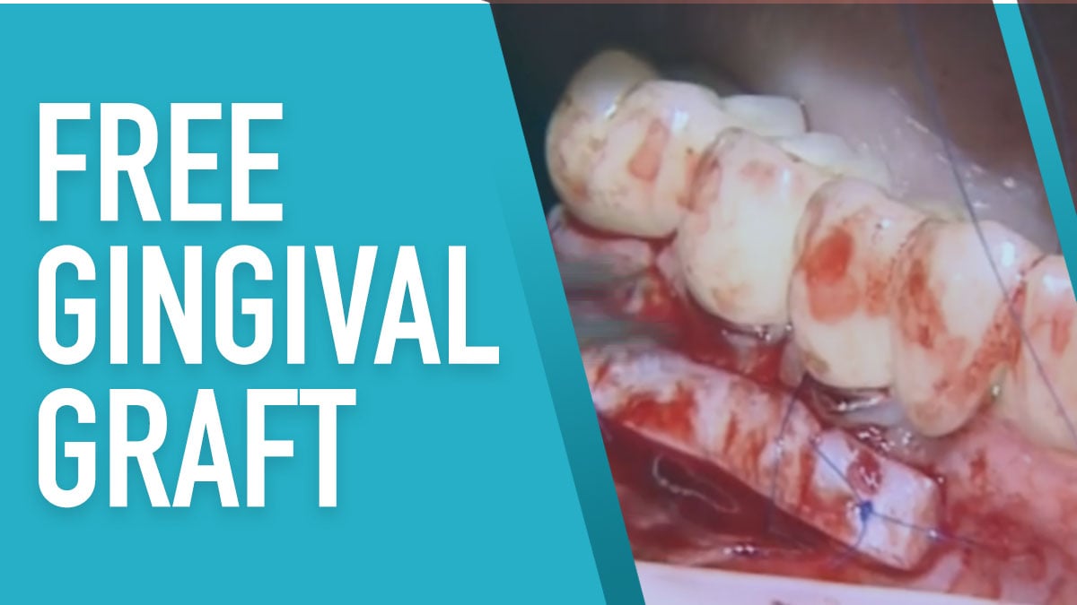 Free Gingival Graft  