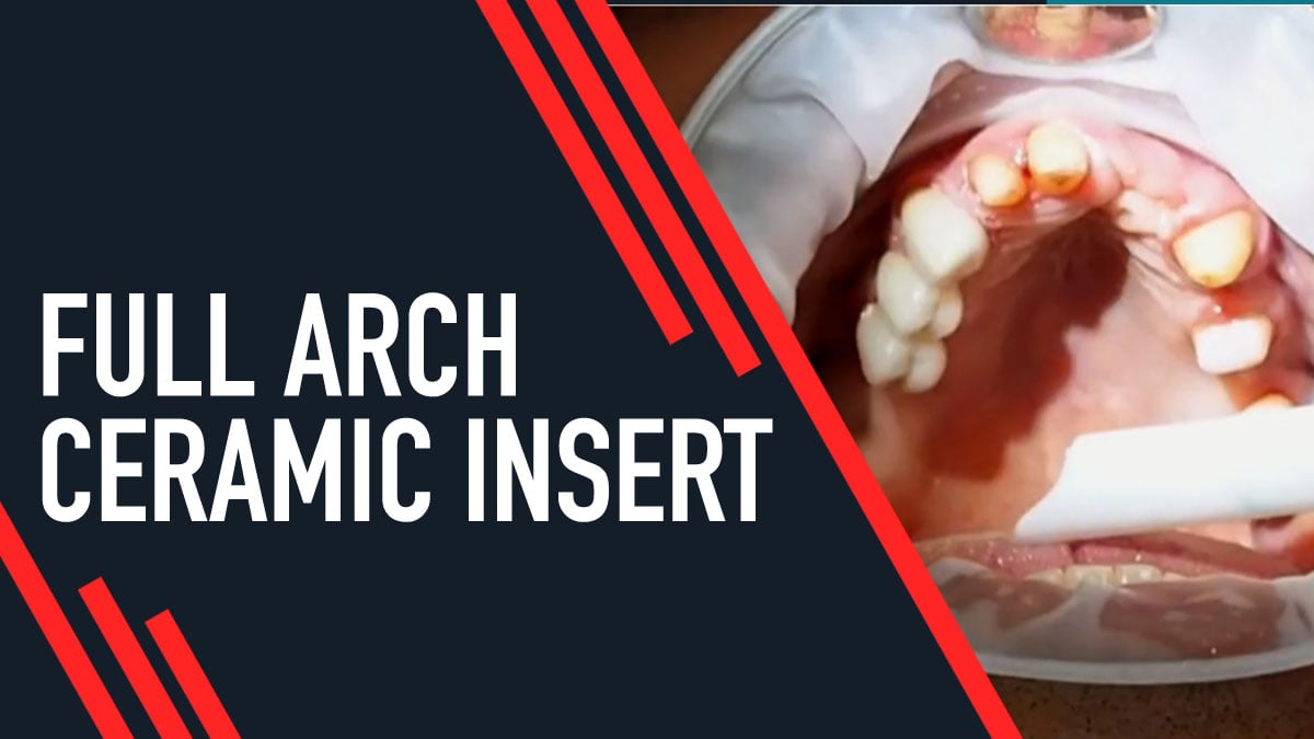 Full Arch Ceramic Insert
