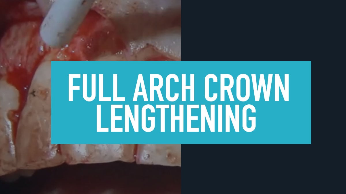 Full Arch Crown Lengthening