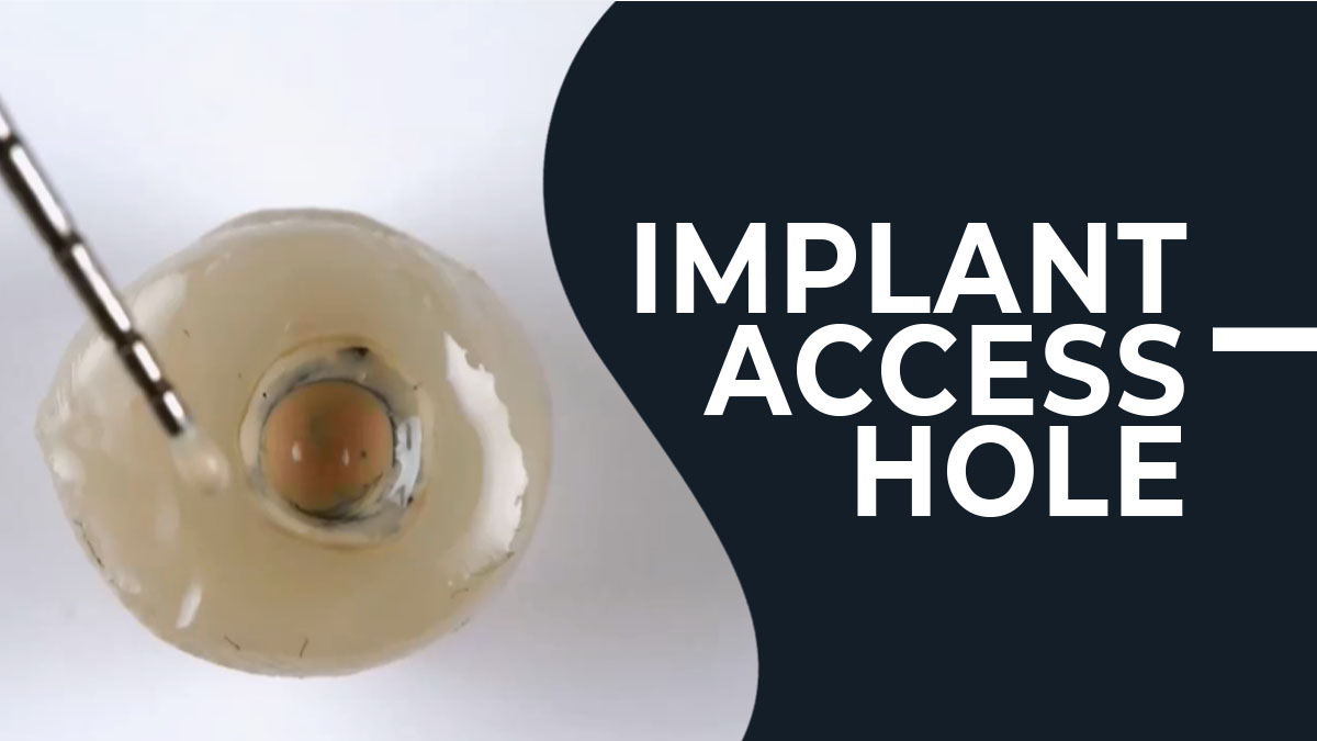 Implant Access Hole