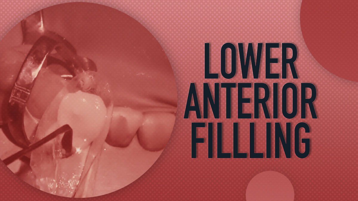 Lower Anterior Filling