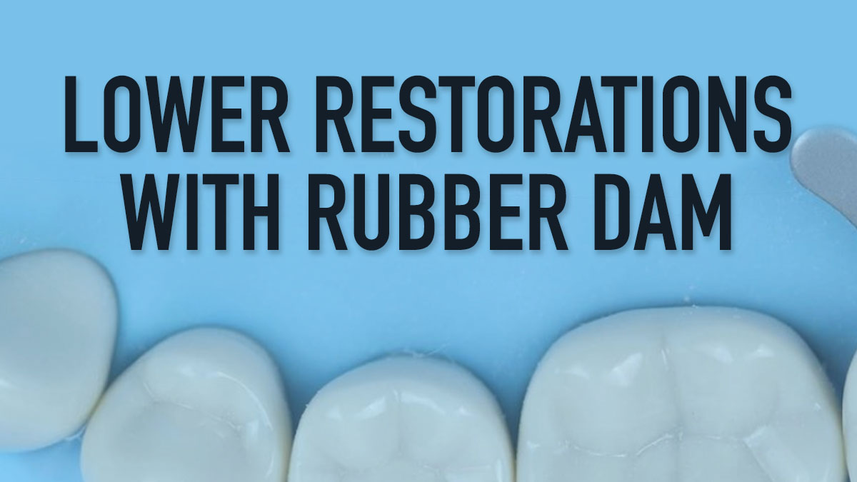 Lower Restorations with Rubber Dam