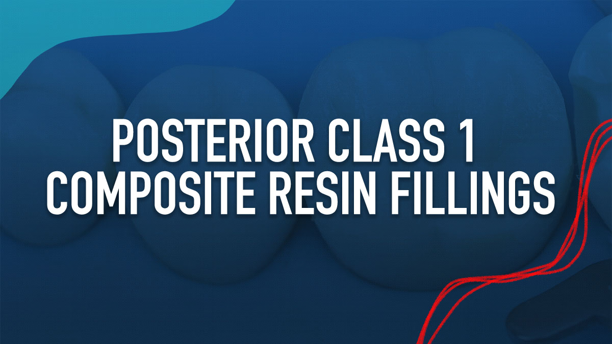 Posterior Class 1 Composite Resin Fillings
