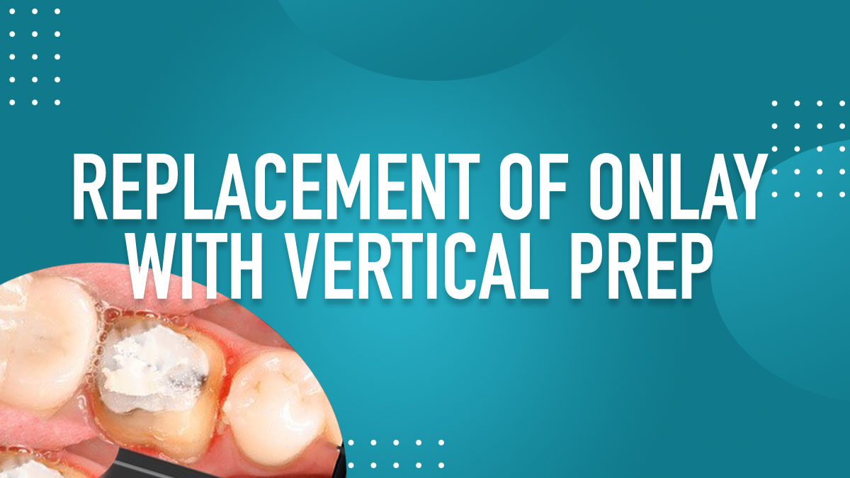 Replacement of Onlay with Vertical Prep