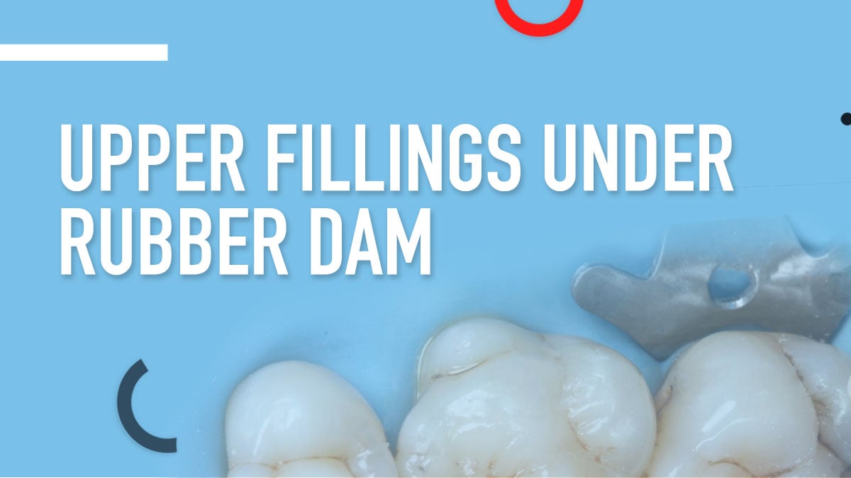 Upper Fillings Under Rubber Dam
