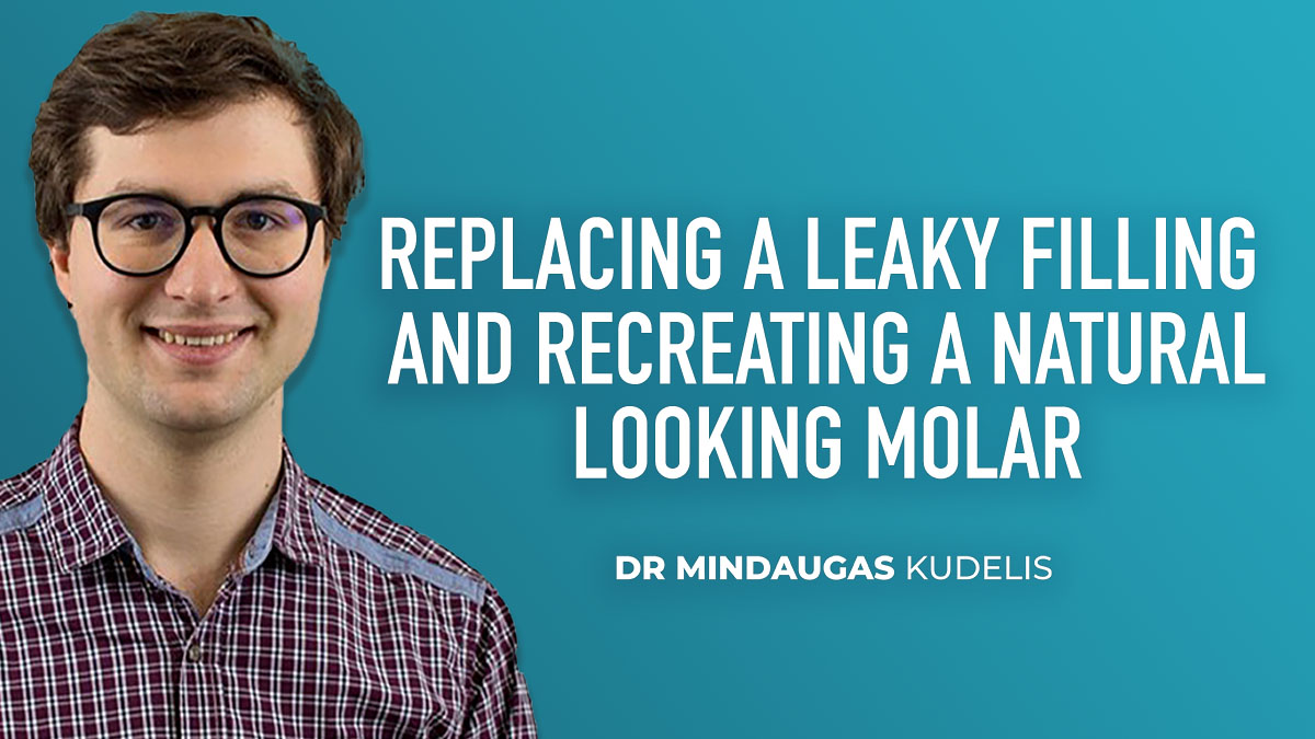 Replacing a Leaky Filling and Recreate a Natural Looking Molar
