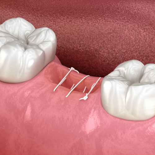 basics of sutures lecture series