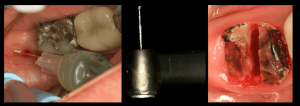 Intra-osseous with Extraction.