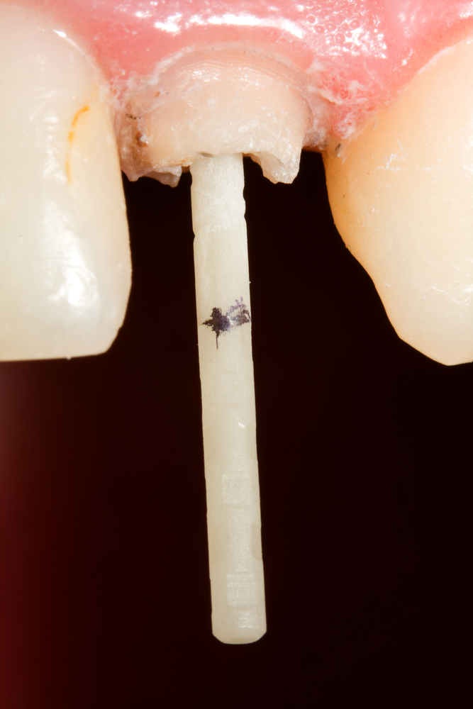 Since metal posts, or cast posts tend not to fracture very often, they do more often fail via root fracture.