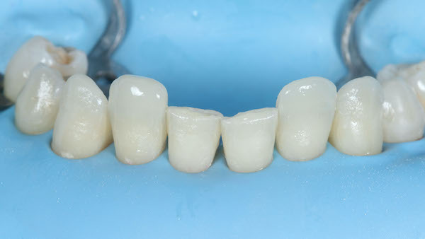 ATP-images-Steward-Ortho-and-veneers-slide-19-600x336-1