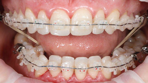 ATP-images-Steward-Ortho-and-veneers-slide-23-600x336-1