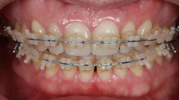 ATP-images-Steward-Ortho-and-veneers-slide-25-600x336-1