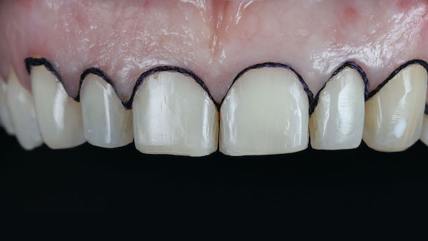 ATP-images-Steward-Ortho-and-veneers-slide-32-600x336-1