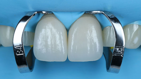 ATP-images-Steward-Ortho-and-veneers-slide-34-600x336-1