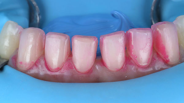 ATP-images-Steward-Ortho-and-veneers-slide-44-600x336-1