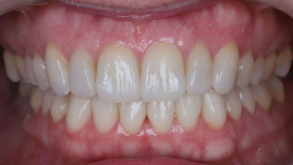 ATP-images-Steward-Ortho-and-veneers-slide-57-600x336-1