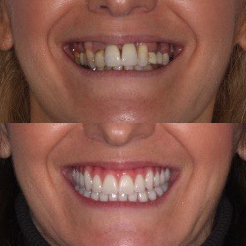 MC280321-all-on-x-rodrigues-patient-3-before-after-800x800-1 MC280321-all-on-x-rodrigues-patient-3-before-after-800x800-1
